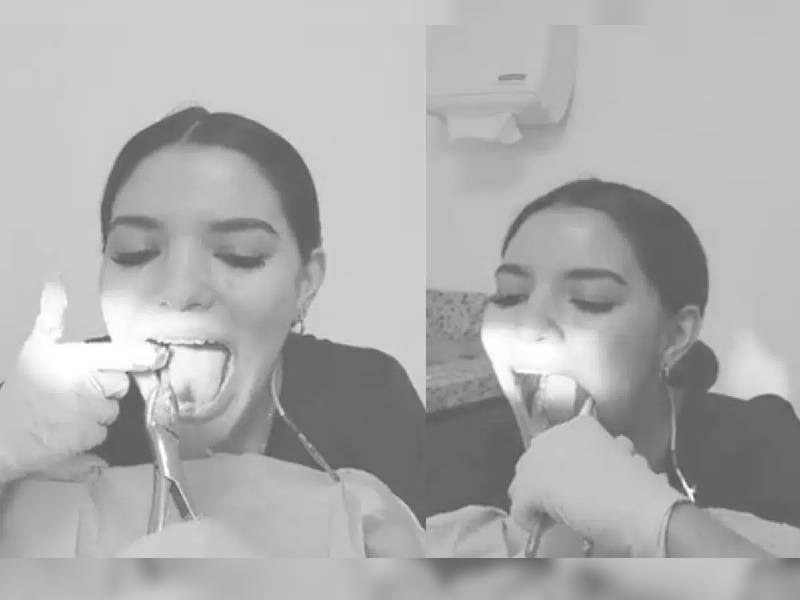 Video. Joven dentista se extirpa ella sola sus muelas del juicio, ¿qué opinas?