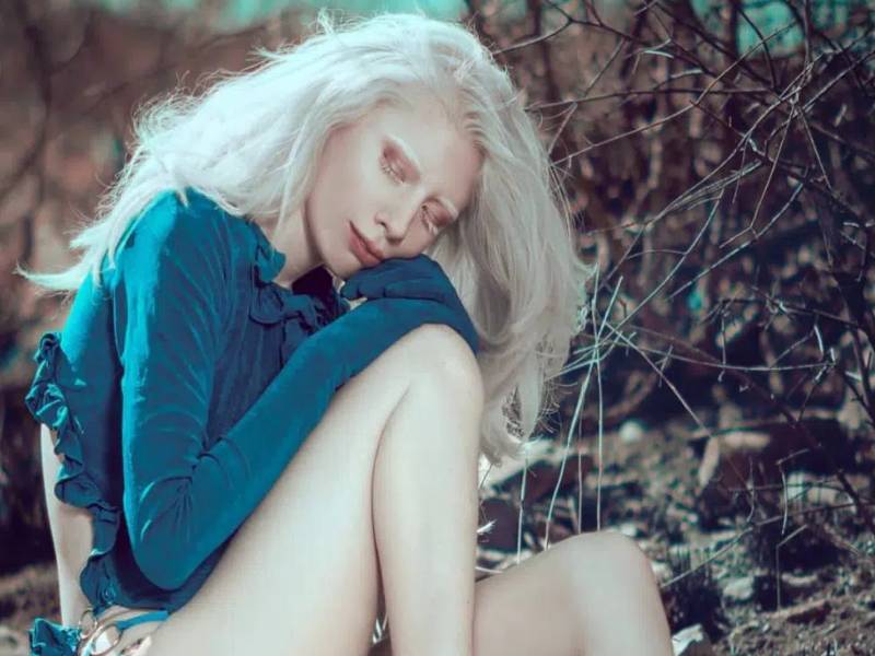 Ruby Vizcarra: La dura vida de una albina mexicana que hoy brilla como modelo