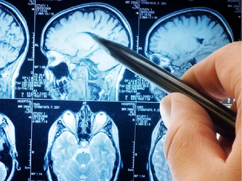 Reducir tumores en el cerebro sin cirugía ya es una realidad