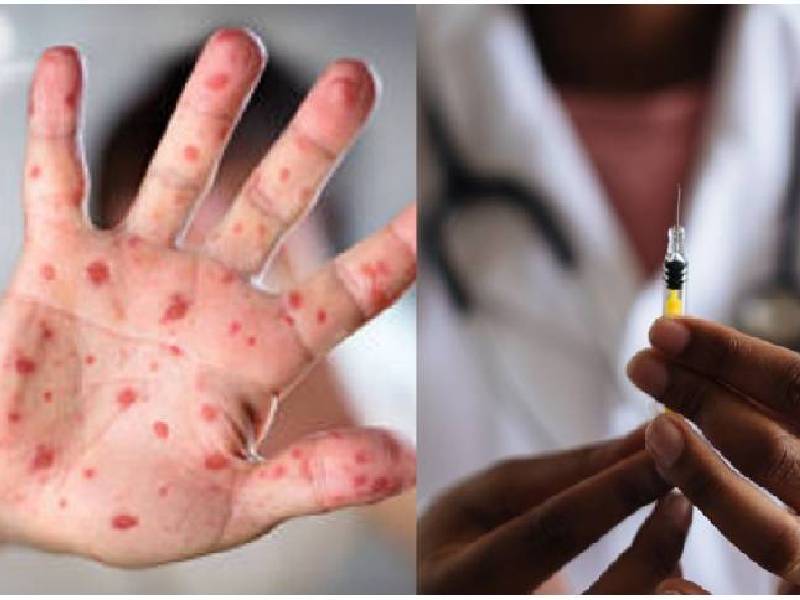Van 60 casos de viruela símica en 11 estados de México: Salud