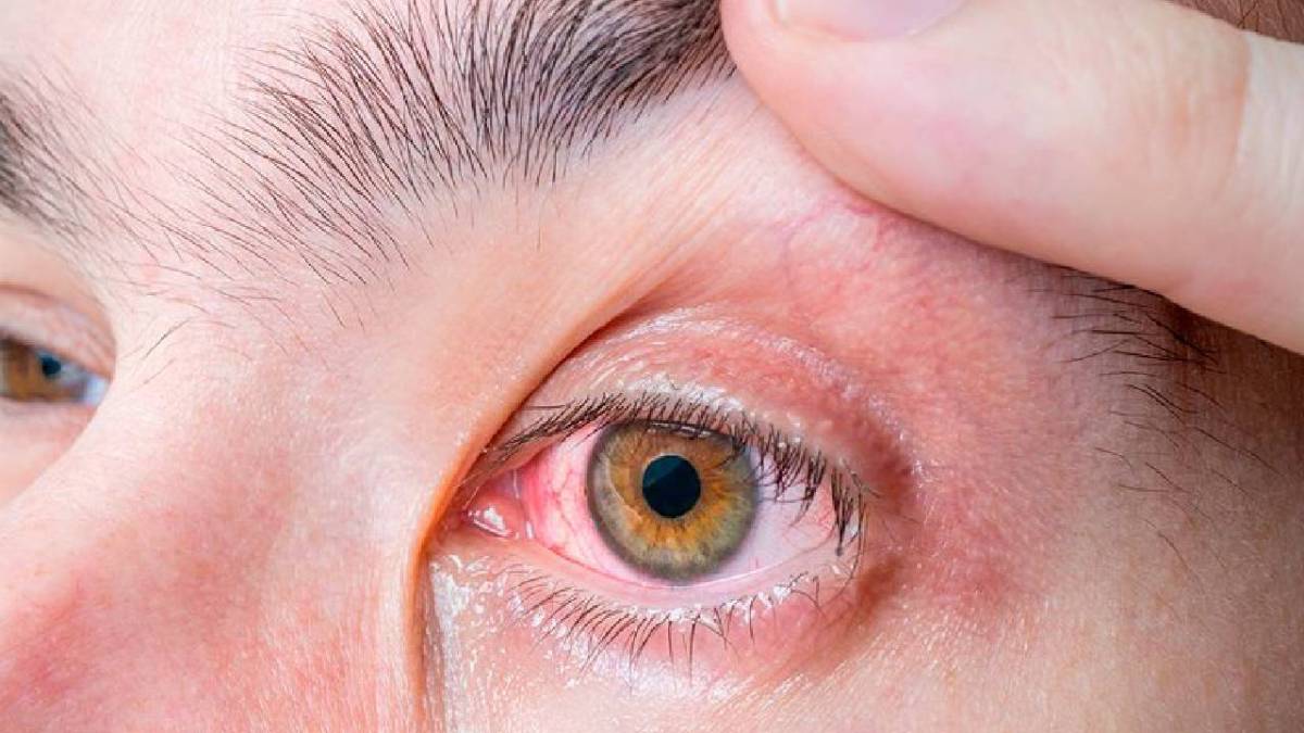 Alertan por casos de conjuntivitis.