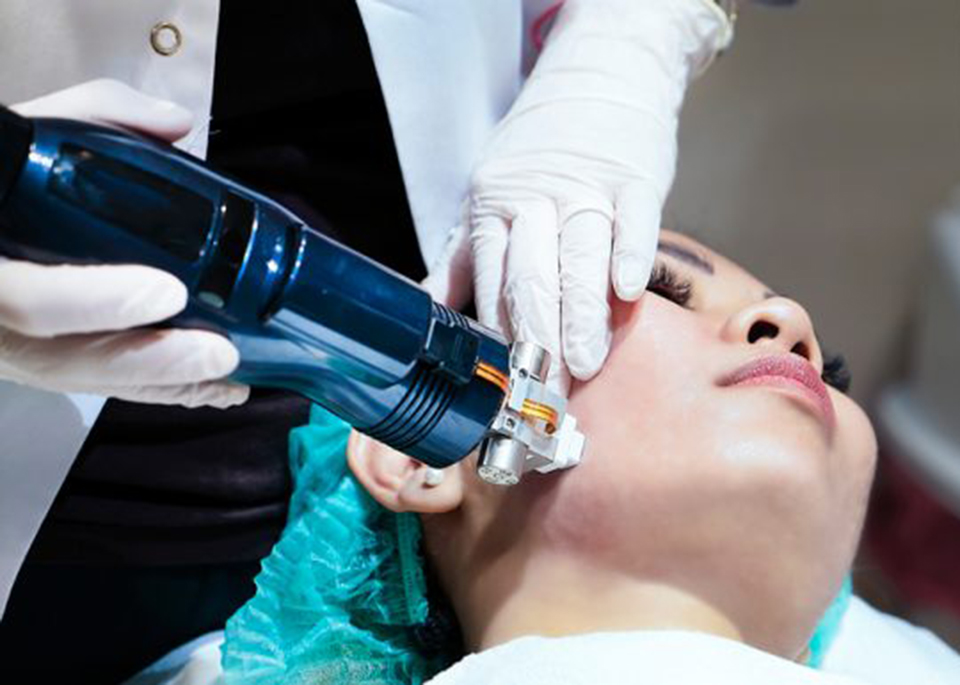 Cicatrices de acné, arrugas, tez apagada... ¿Por qué no probar microneedling? Este nuevo tratamiento de la piel hecho con pequeñas agujas promete una piel perfecta.