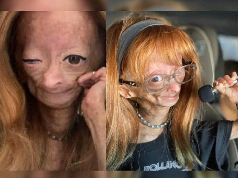 Fallece Adalia Rose la youtuber con la enfermedad de Benjamin Button