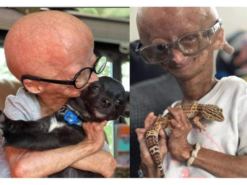 la extraña enfermedad de Benjamin Button