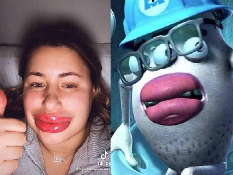 Mujer sufre reacción alérgica al relleno de labios y se vuelve viral