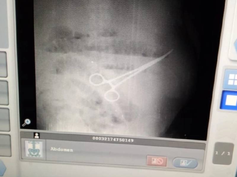 Muere paciente debido a tijeras que médicos dejaron en su interior