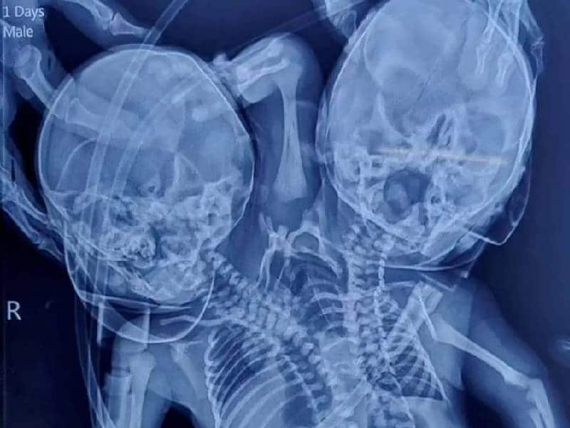 Nace bebé con 2 cabezas, 2 corazones y 3 brazos