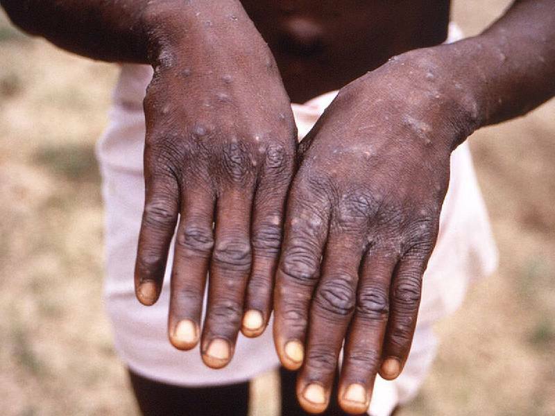 Confirman primer casos de Viruela del Mono en América