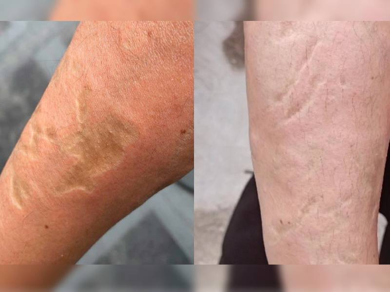 Dos sujetos atacan a mujer con ácido sulfúrico