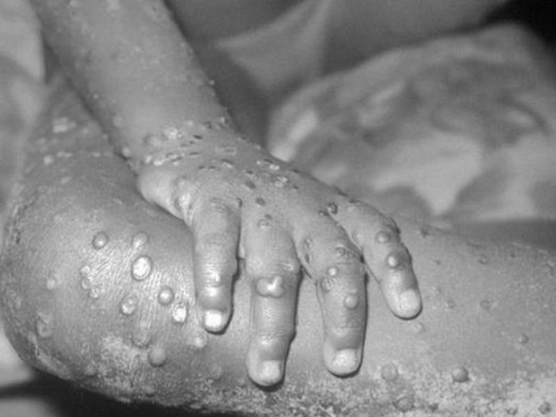 Se confirma dos casos en Edomex de viruela de mono