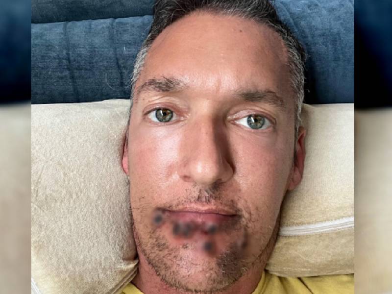 Video. Actor nopor pide compasión para pacientes de viruela del mono