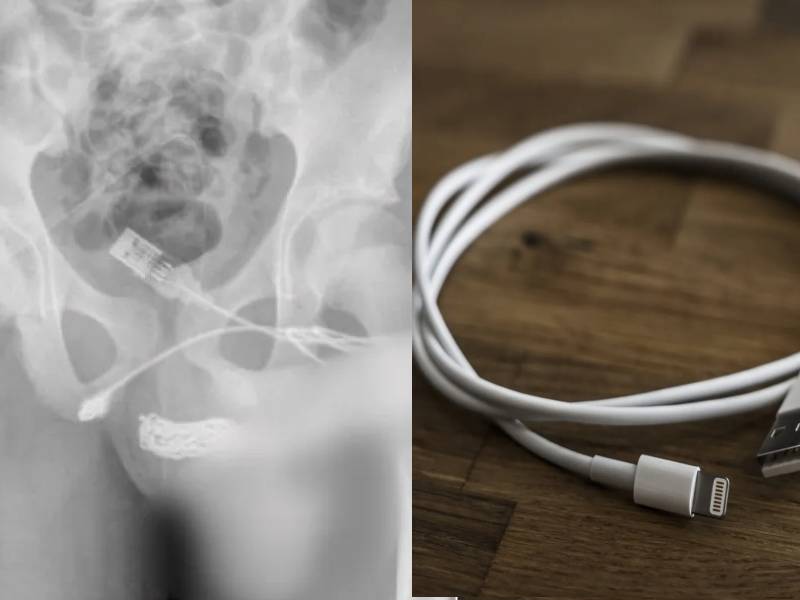Adolescente se introdujo un cable USB para medir su miembro