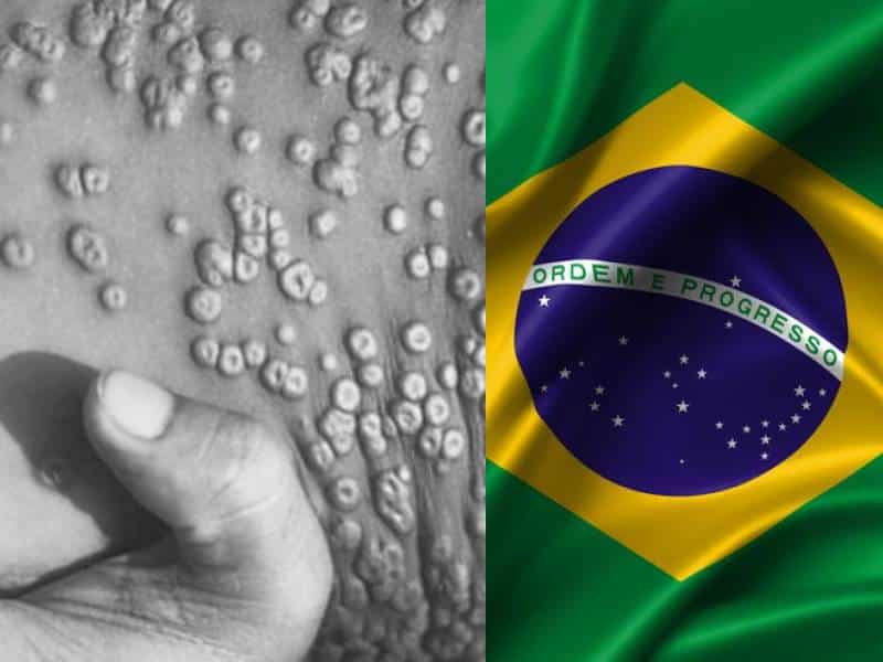 viruela del mono brasil