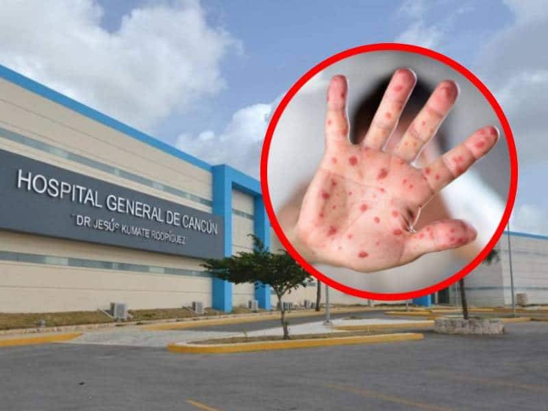 Q. Roo y Yucatán con más viruela del mono