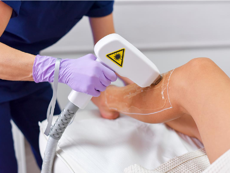 ¿Depilación láser? Checa estos consejos