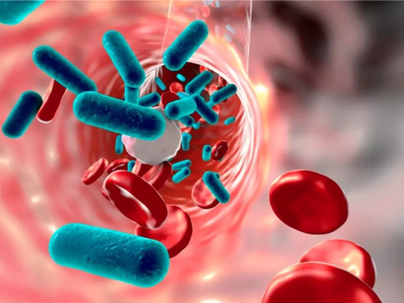 Sepsis