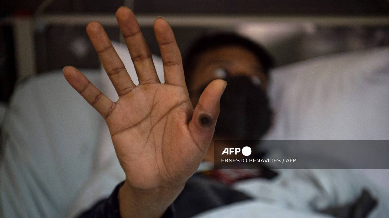 Esta fotografía de archivo tomada el 16 de agosto de 2022 muestra a un paciente mostrando su mano con una llaga causada por una infección del virus de la viruela del mono.