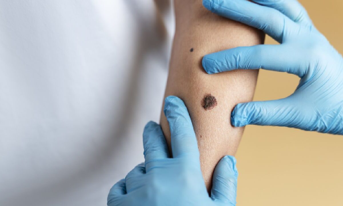 Anuncian campaña de prevención de rickettsiosis.