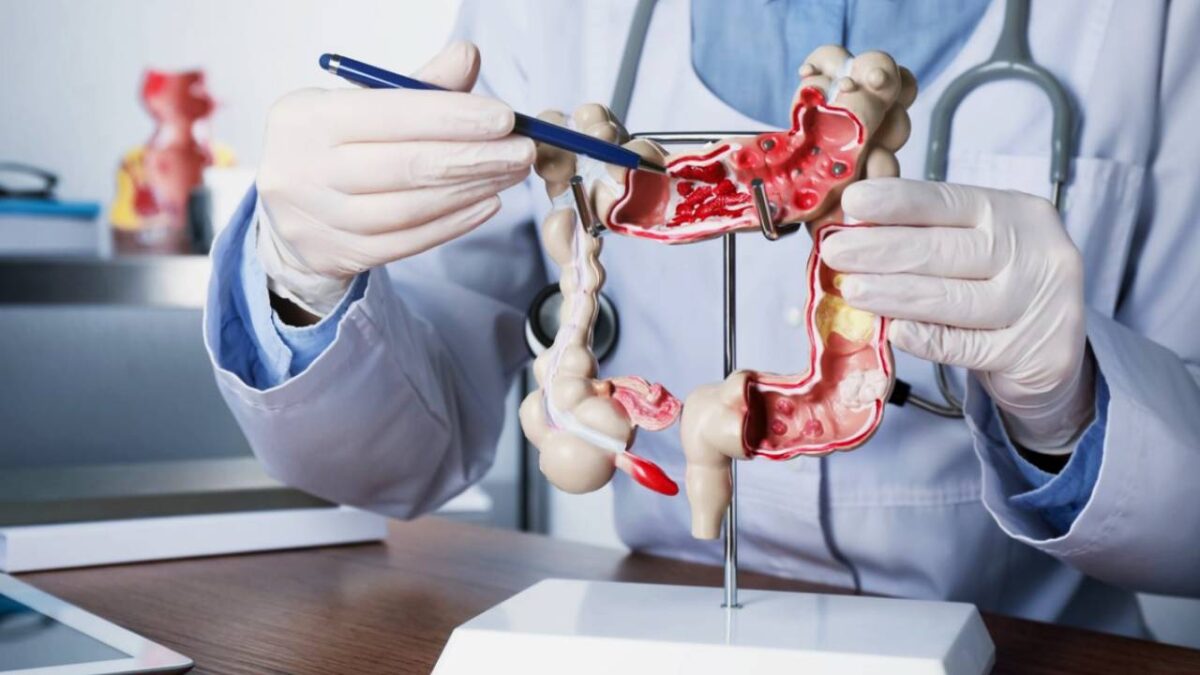 Cáncer colorrectal.