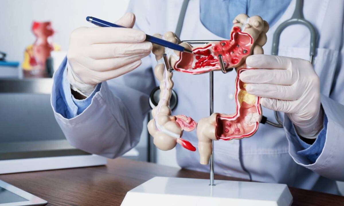 Cáncer colorrectal.