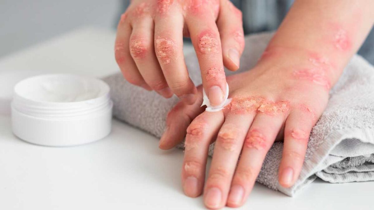 Primera muerte de viruela símica.