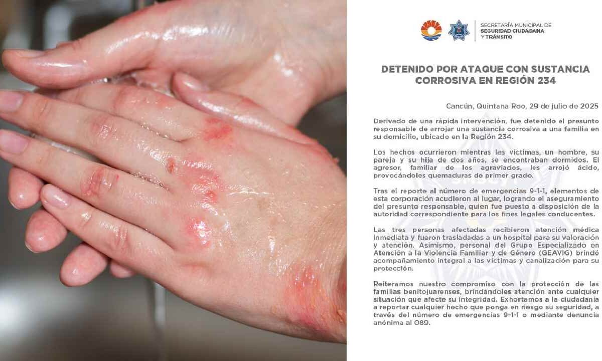 Detenido por ataque con ácido.